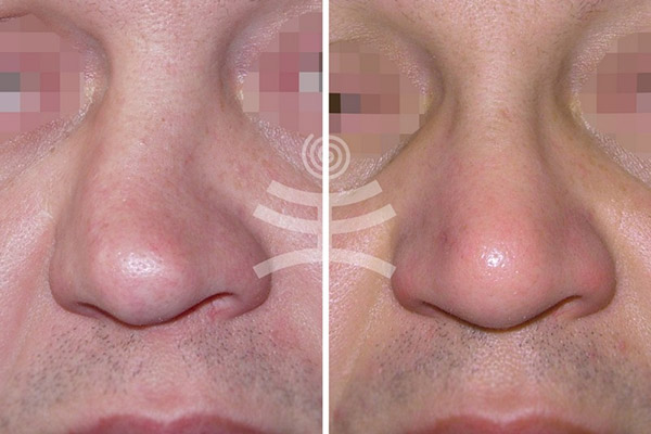 фото до и после восстановления сломанного носа внешним доступом