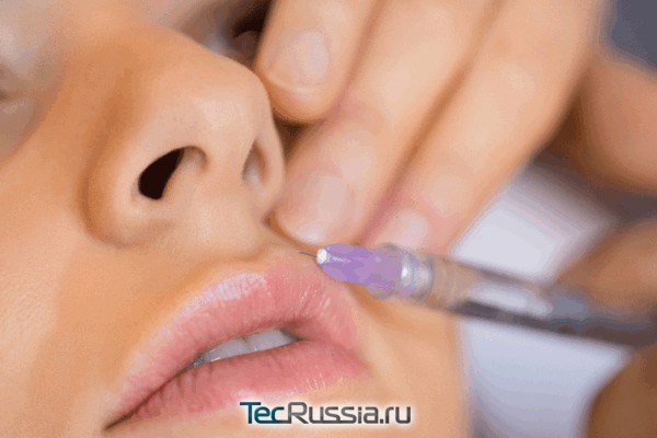 процедура контурной пластики губ