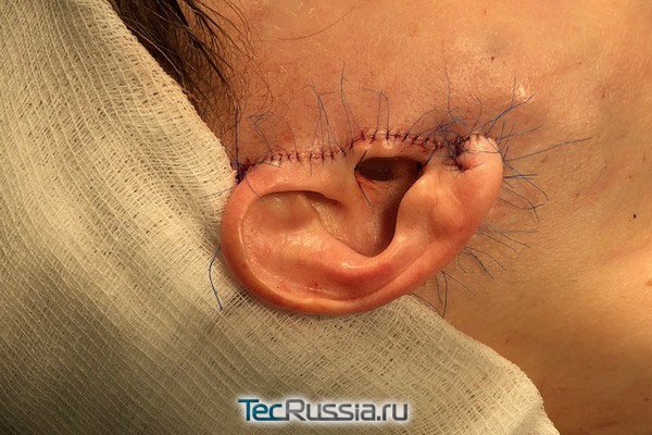 коррекция деформации мочки уха хирург Кудинова