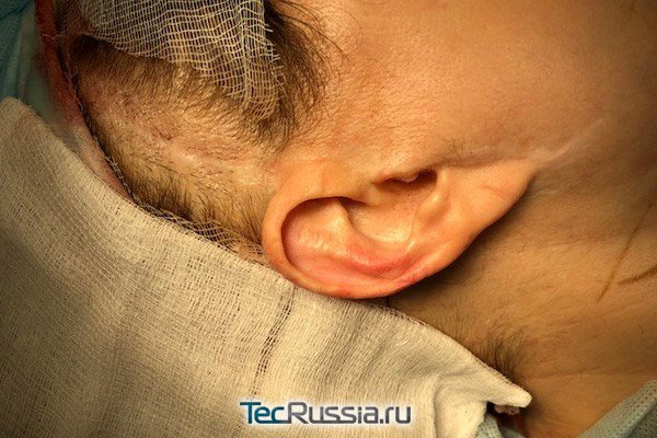 проведение операции по коррекции деформации мочки уха