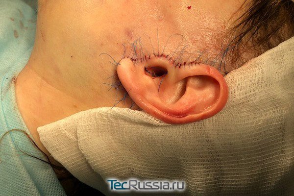 коррекция деформации мочки уха доктор Кудинова
