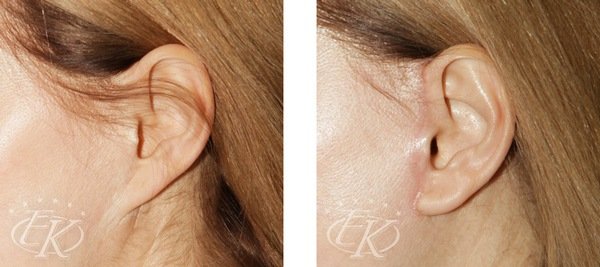 фото коррекции деформации мочки уха