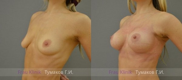 эндоскопическое увеличение груди через подмышечную впадину до и после