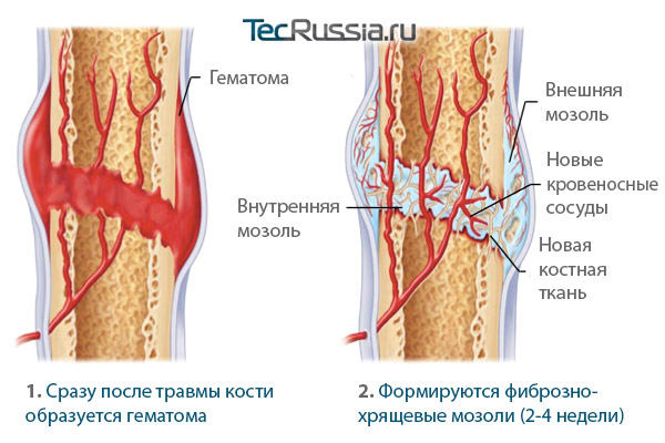 стадии заживления сломанной кости: формирование внутренних и внешних мозолей