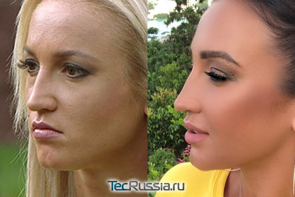 Ольга Бузова до и после увеличения груди