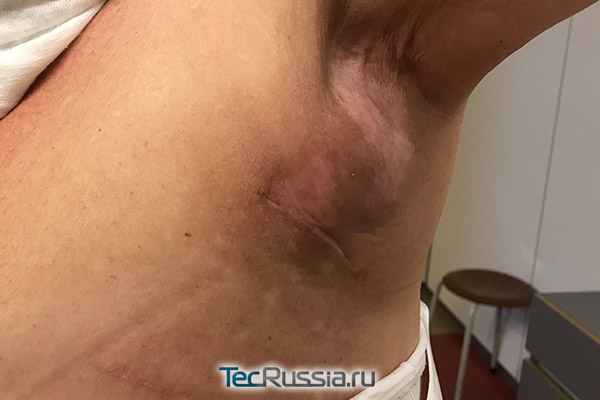 Серома после маммопластики на узи что делать. Смотреть фото Серома после маммопластики на узи что делать. Смотреть картинку Серома после маммопластики на узи что делать. Картинка про Серома после маммопластики на узи что делать. Фото Серома после маммопластики на узи что делать