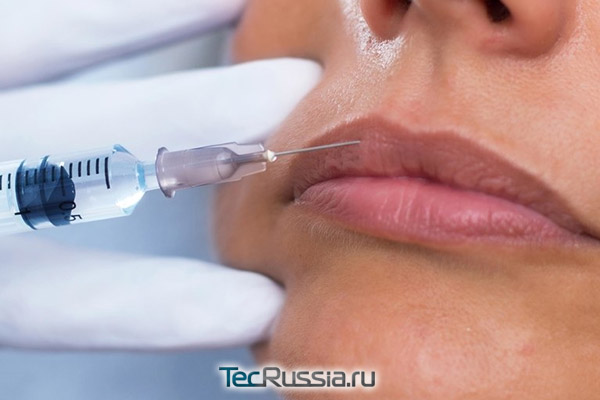 инъекции гиалуронидазы в губы