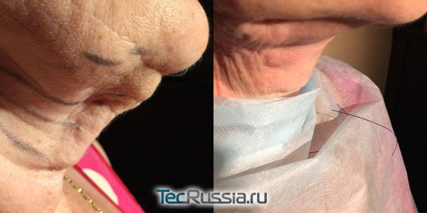 фото до и после нитевой подтяжки шеи