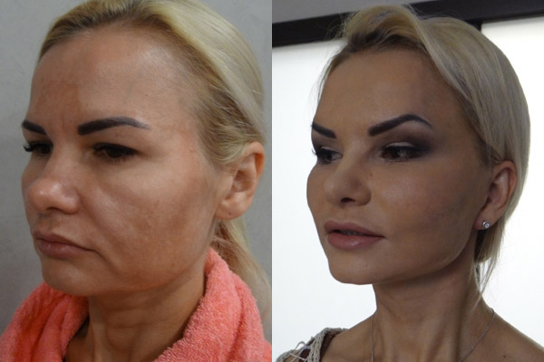 фото до и после пластики лица, хирург - Шах Г.Ш.