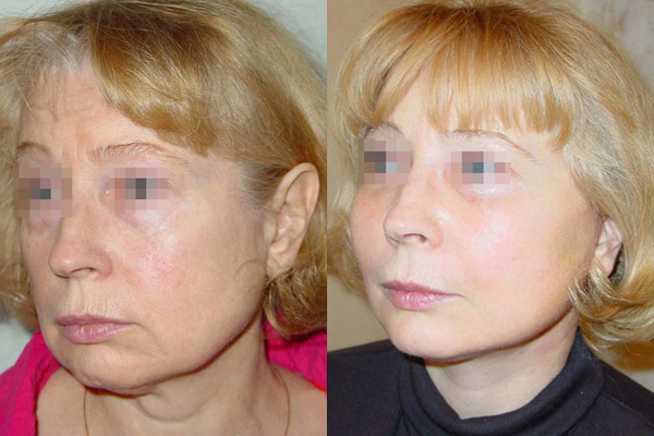 фото до и после лифтинга средней зоны лица, хирург - Гульнара Шах