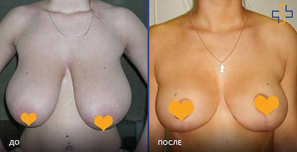 фото до и после уменьшения груди, хирург – Олег Ведров