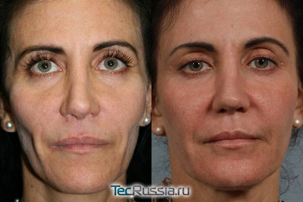 фото до и после коррекции лицевой липодистрофии