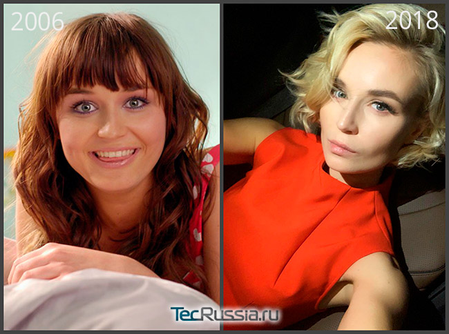 фото Полины Гагариной до и после операции по удалению комков Биша
