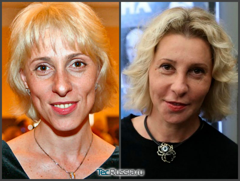 Юлия Рутберг до и после пластики лица