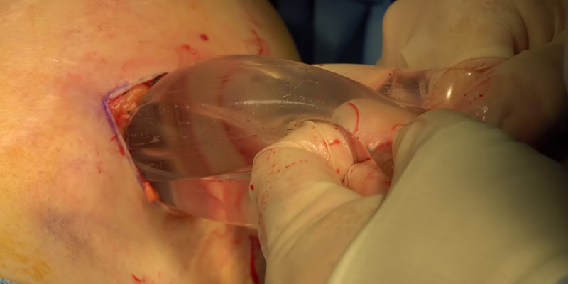 извлечение грудного импланта в ходе корректирующей операции