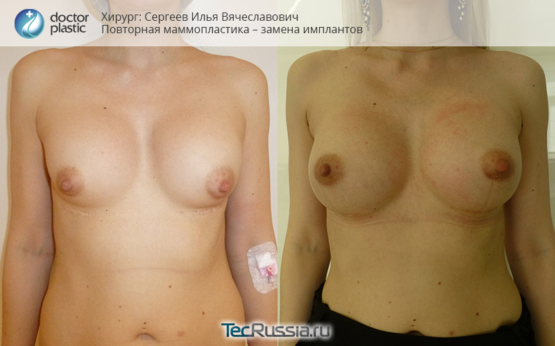 фото до и после корректирующей операции с заменой грудных имплантов на большие