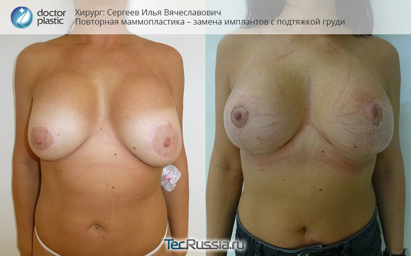 фото до и после повторной пластики груди с подтяжкой у доктора Сергеева
