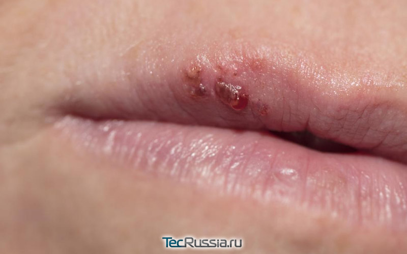 При герпесе можно увеличивать губы гиалуроновой кислотой thumbnail