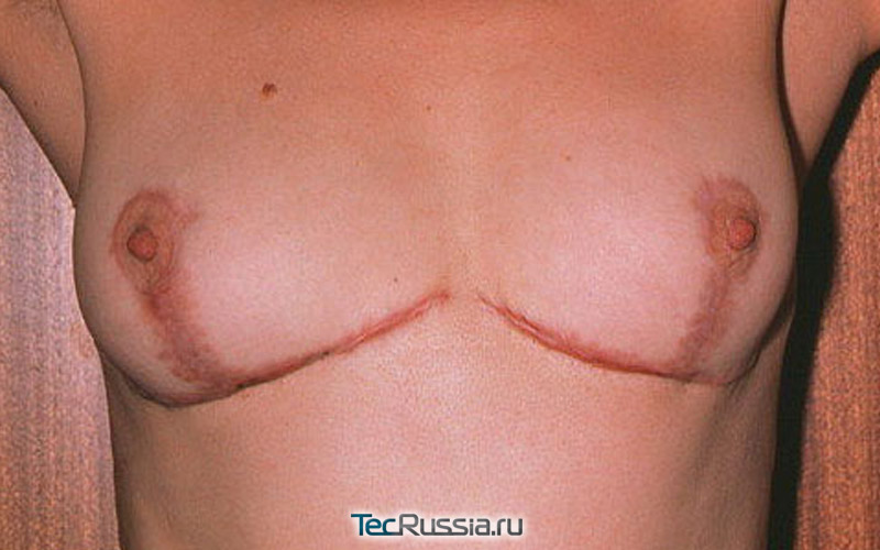 грубые келоидные рубцы после подтяжки груди