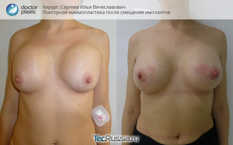 коррекция смещения имплантов, фото до и после