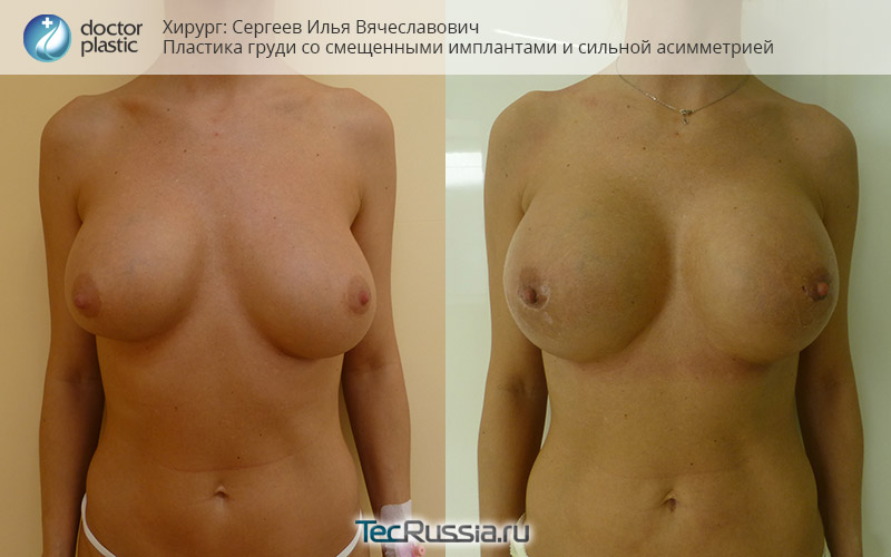 сдвинутый имплант и асимметрия груди, фото до и после пластики