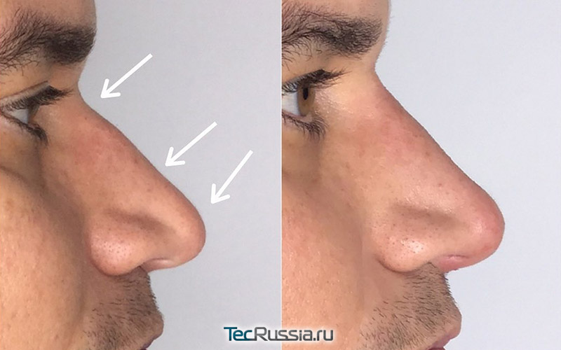 фото до и после выравнивания спинки носа филлером