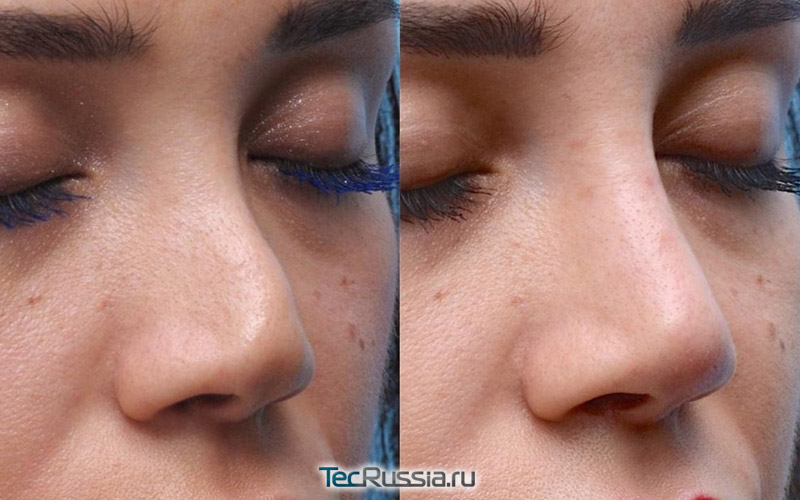 фото до и после коррекции носа филлерами