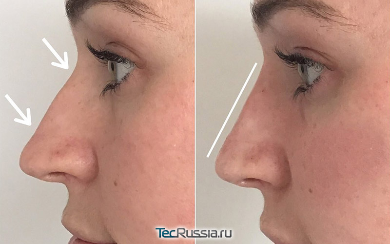 фото до и после введения гиалуроновой кислоты в нос