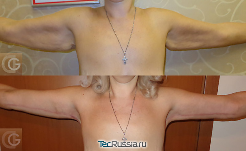 фото до и после брахиопластики, хирург Гагарина С.В.