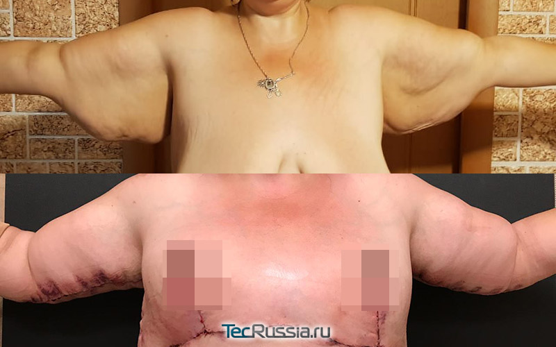 фото до и после пластики рук, хирург Гагарина