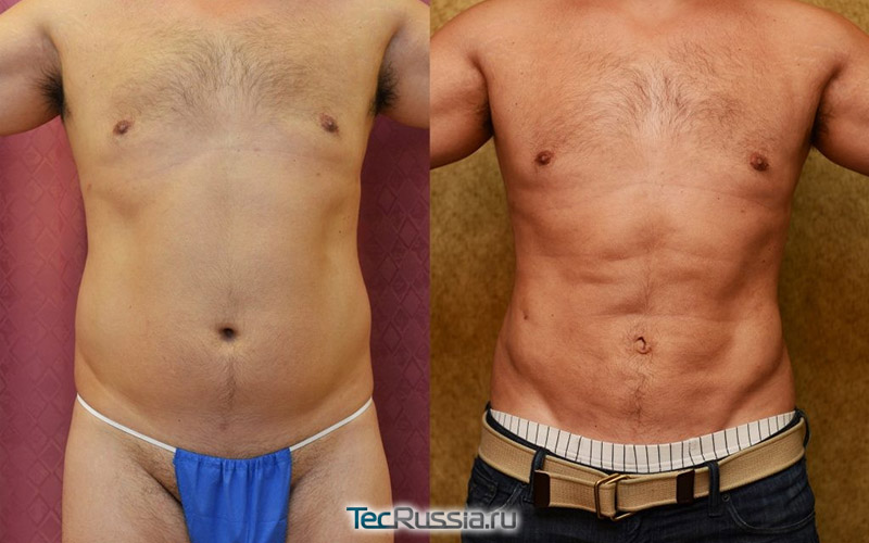 липосакция мужчине, фото до и после удаления жира