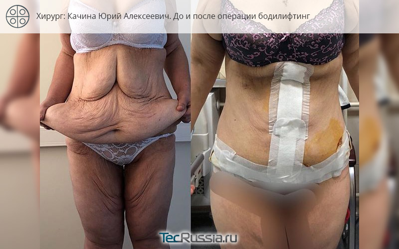 фото до и после операции бодилифтинг