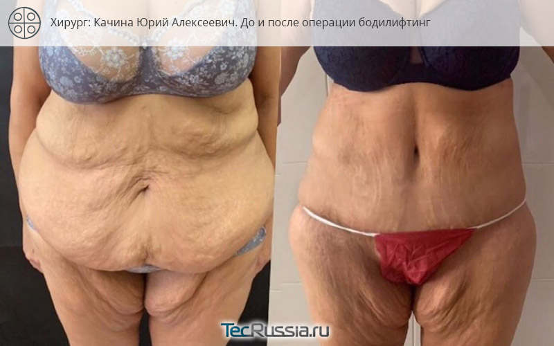 фото до и после бодилифтинга и торсопластики, хирург Юрий Качина