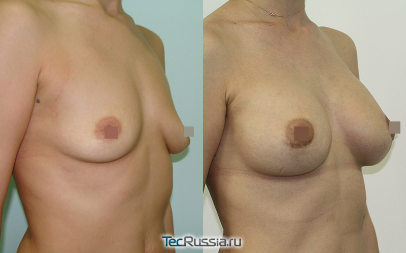Фото до и после мастопексии с увеличением груди, хирург И.В. сергеев