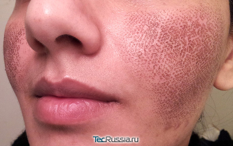 коричневые следы от лазерного термолиза на лице
