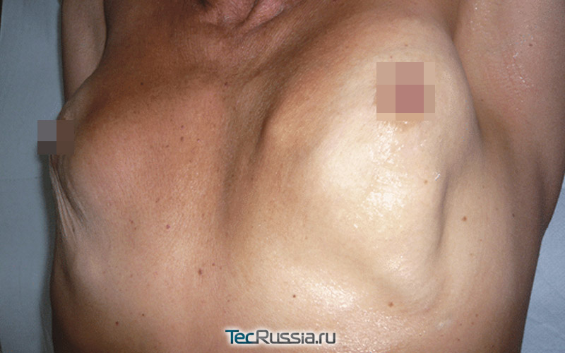 уплотнения и деформации в груди после увеличения гиалуроновой кислотой