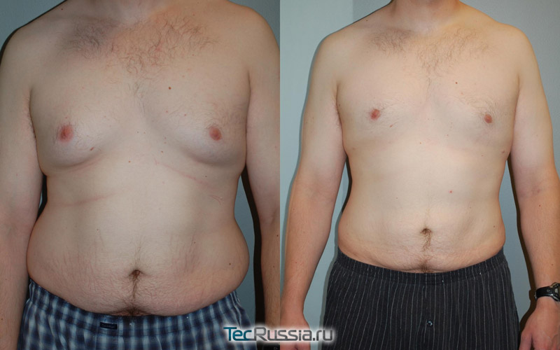 фото до и после липосакции у мужчины при гинекомастии