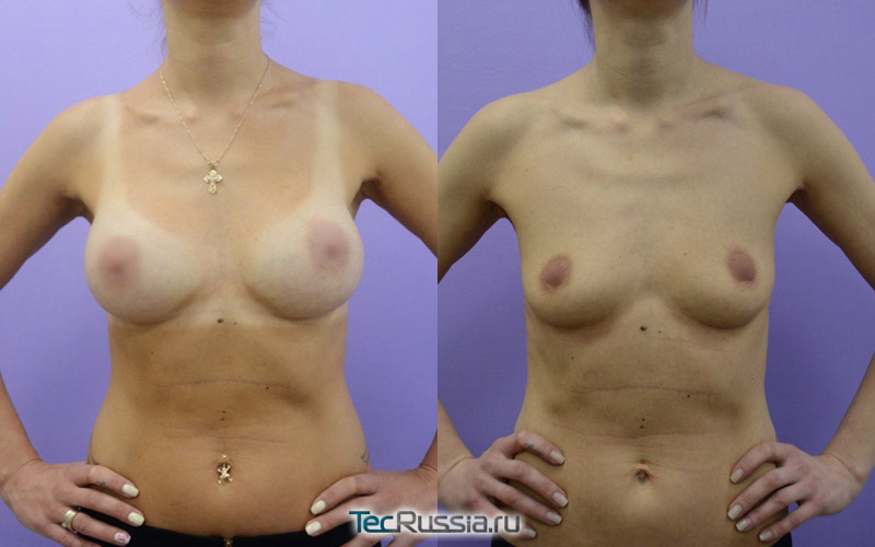 Фото до и после удаления имплантов из груди