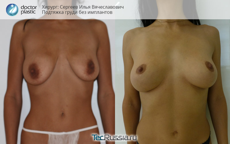 фото до и после подтяжки груди без имплантов
