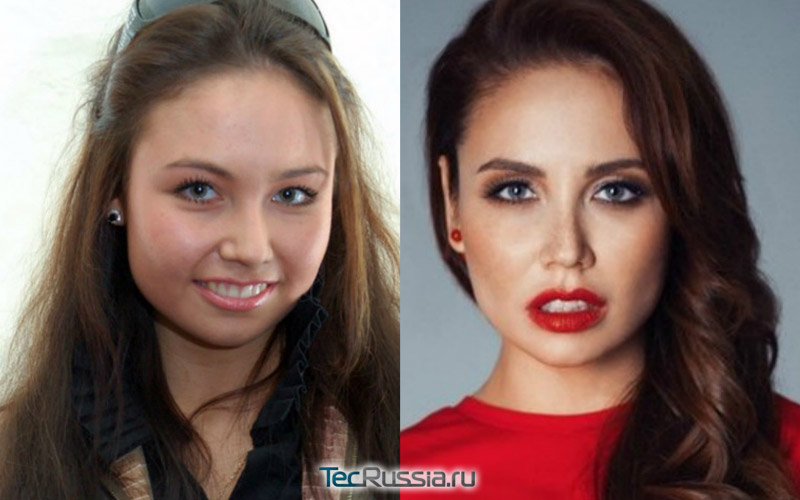 фото Утяшевой до и после операций