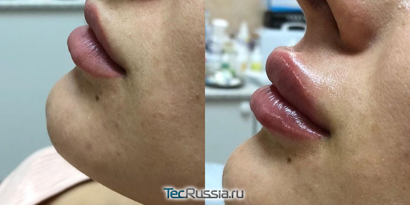 Фото до и после увеличений губ филлером Renaissance Lips