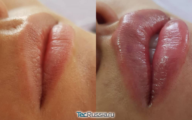 фото до и после увеличения губ корейским филлером Neuramis