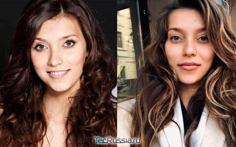 фото Регины Тодоренко до и после увеличения губ филлерами