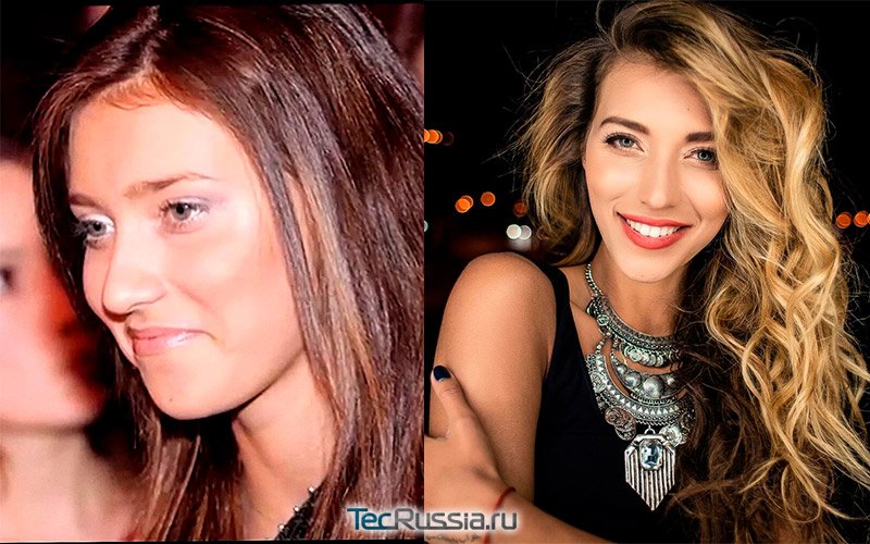 Регина Тодоренко сделала ринопластику – фото до и после