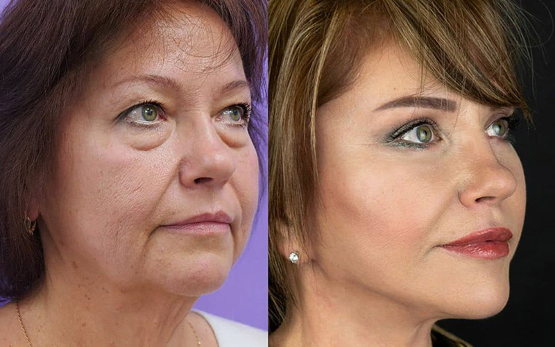 Елена до и после подтяжки лица у доктора Тумакова