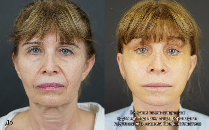 пациентка до и на пятый день после круговой подтяжки лица и блефаропластики