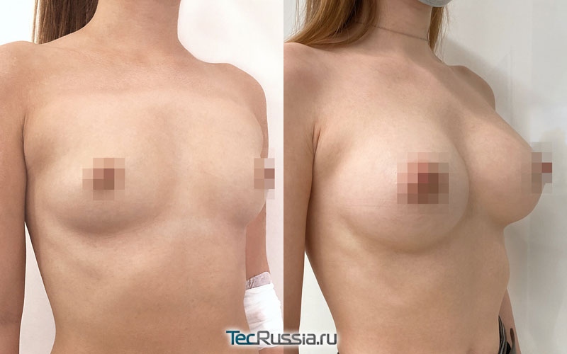 фото до и после операции по пластике груди, хирург Сергеев И.В.