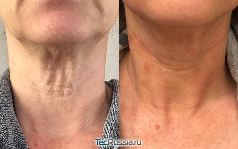 фото до и после микронидлинга кожи на шее