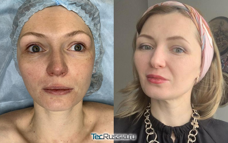 фото до и после биоревитализации препаратом Veronica Revital Expert