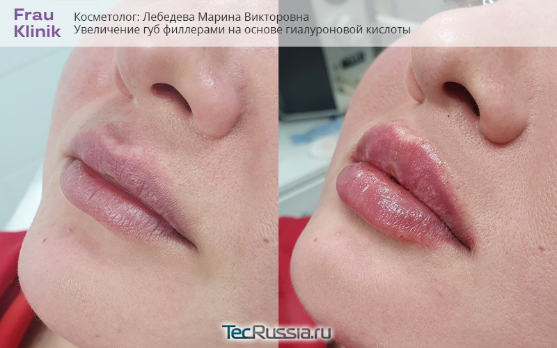 фото до и после увеличения губ филлерами гиалуроновой кислоты